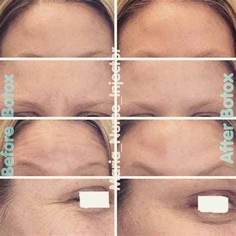 The Difference Between Botox Xeomin Dysport And Jeuveau — Top Rated