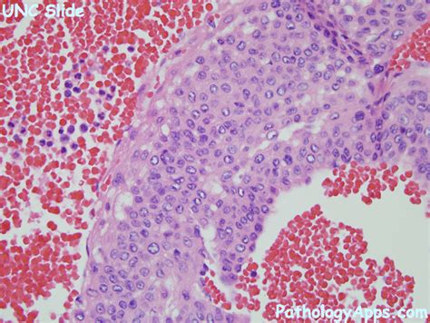 glomus tumor pathology