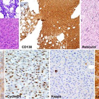 Standard H E And Immunohistochemical Staining In Bone Marrow Biopsy