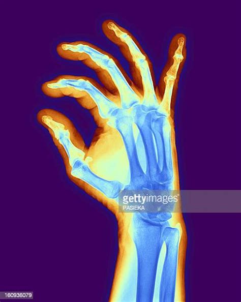 25 Hand Osteoarthritis High Res Illustrations - Getty Images