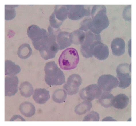 A Peripheral Blood Smear Of Case 2 Showed Immature Schizonts Form Of