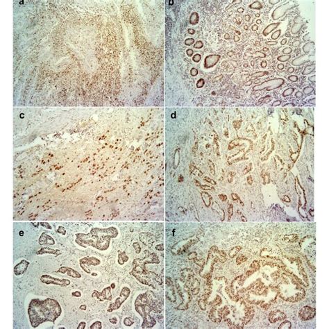 Immunohistochemical Staining Of Mismatch Repair Proteins With The