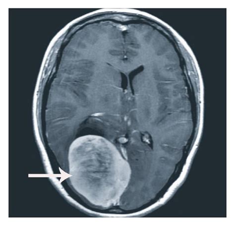 The Contrast T1wi Image Of Right Occipital Lobe Meningioma In A