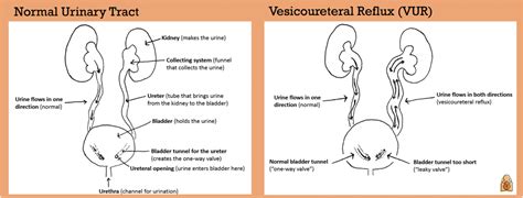 Vesicoureteral Reflux Vur In Infants And Children National Kidney