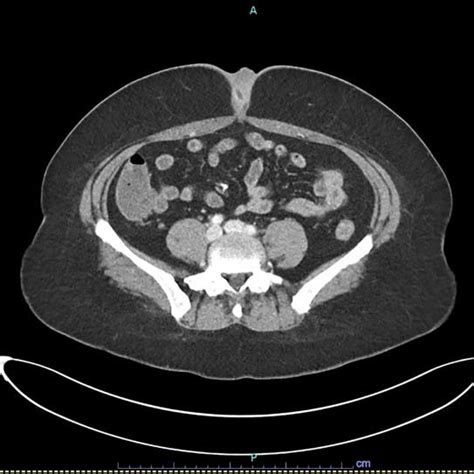 Axial Slice Of Contrast Enhanced Ct Scan Showing Umbilical Soft Tissue