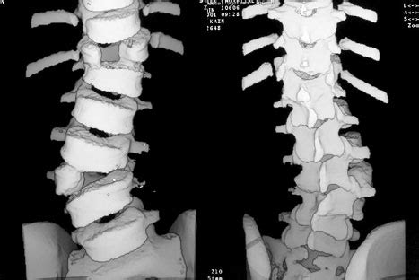 Photo Gallery - Scoliosis