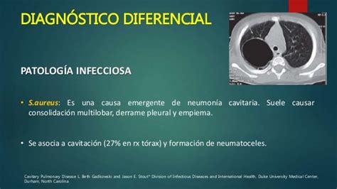 Lesiones Pulmonares Cavitadas