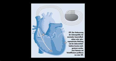 Biventrikul Re Schrittmacher Und Defibrillatoren Bei Herzinsuffizienz