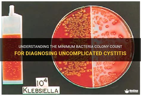 Understanding The Minimum Bacteria Colony Count For Diagnosing