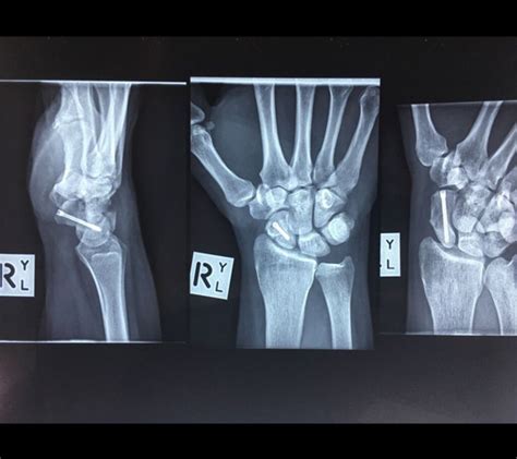 Scaphoid Fractures Dr Nicholas Smith