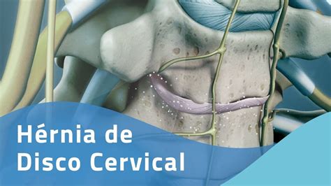 H Rnia De Disco Cervical Youtube