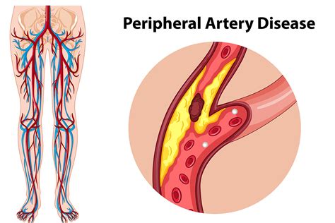 How To Treat And Prevent Peripheral Artery Disease PAD Martin Foot