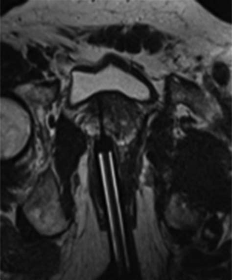 Mri Gantry Hot Sex Picture