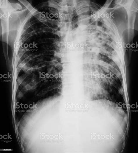 Tuberculosis Lung X Ray