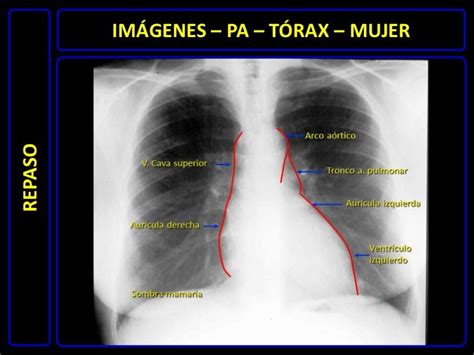 Diagnóstico Por Imágenes Radiografía De Tórax Normal