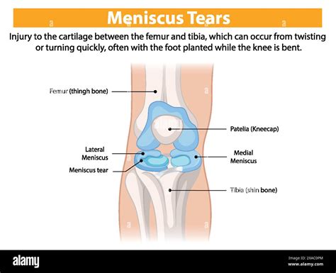 Illustration Of Knee Meniscus Tear Anatomy Stock Vector Image Art Alamy