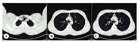 Case Axial Thoracic Computed Tomography Showing Free Air Density