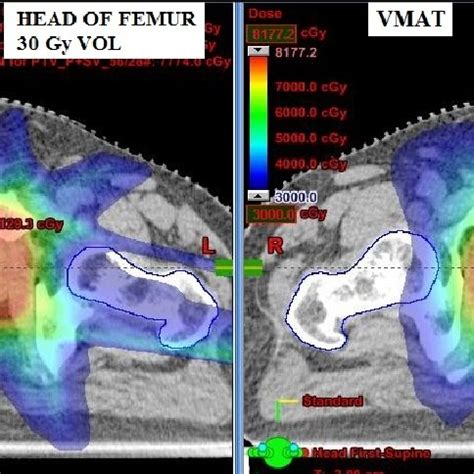 An Example Of Dose Distribution Between Vmat And Imrt Breast Cancer