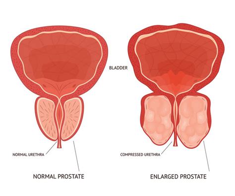 BENIGN PROSTATE ENLARGEMENT: Causes, Symptoms and Diagnosis ...