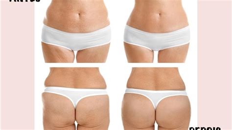 Como é feita a radiofrequência na barriga e glúteos para gordura