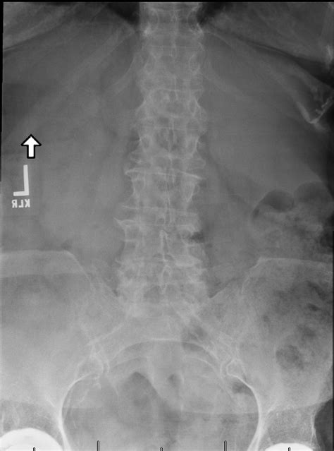 Sacral Fracture Treated with Lumbar to Pelvis Fusion | Houston ...