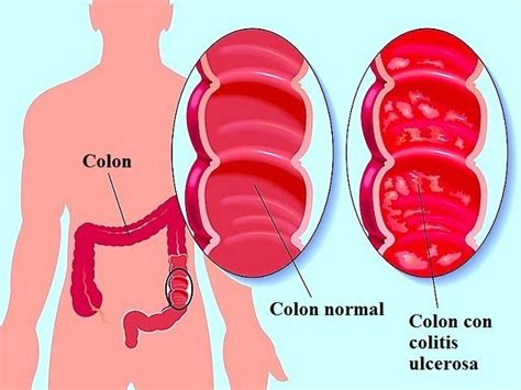 Colitis Ulcerosa Qué Es Síntomas Tratamiento Y Dieta