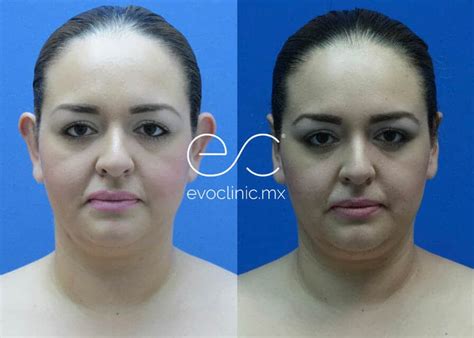 Before & After | Enhance your appearance | evoclinic