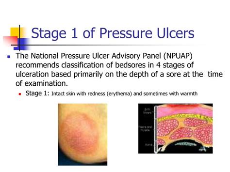 Stage 4 Pressure Ulcer Treatment