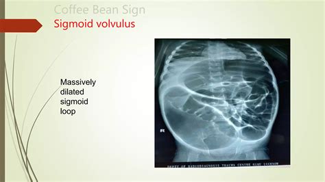 Abdominal X Ray Interpretation Ppt Ppt