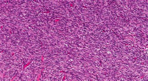 Dermatofibrosarcoma protuberans | Ottawa Atlas of Pathology