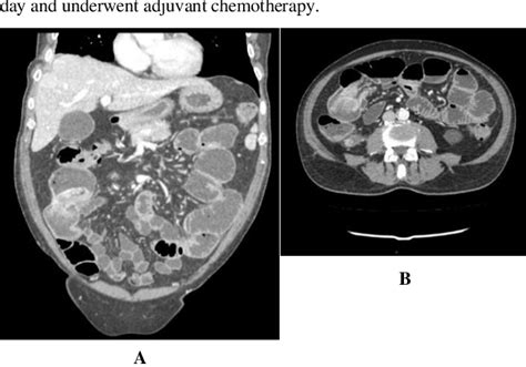 Figure 1 From A Surprising Finding Of Ileal Intussusception Caused By Pleural Mesothelioma