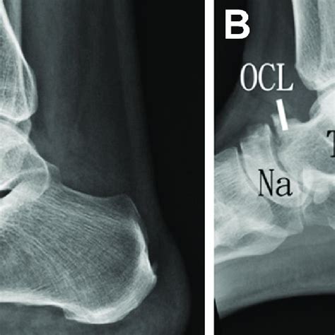 Arthroscopic debridement and microfracture of osteochondral lesion... | Download Scientific Diagram