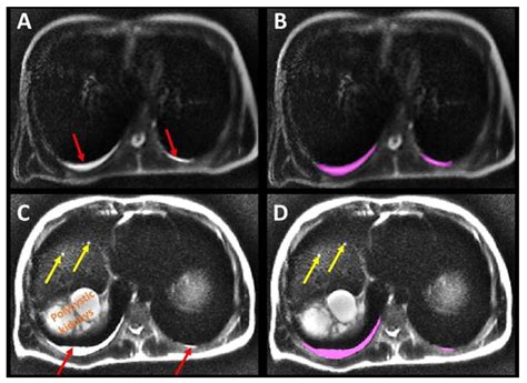 Jcm Free Full Text Pleural Effusions On Mri In Autosomal Dominant