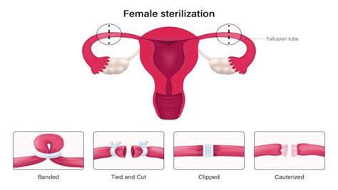 Ectopic Pregnancy After Tubal Ligation What You Need To Know