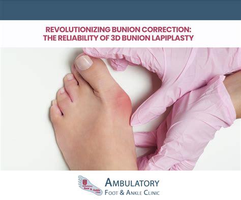 Revolutionizing Bunion Correction The Reliability Of 3D Bunion