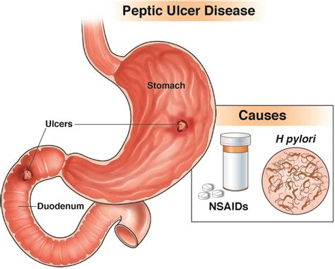 Nsaid Ulcers Treatment