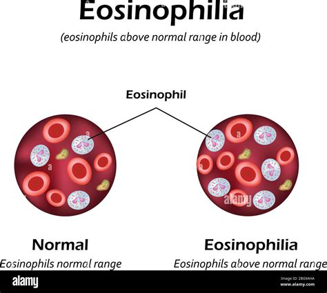 Eosinophils above normal range in blood. Eosinophilia. Infographics ...