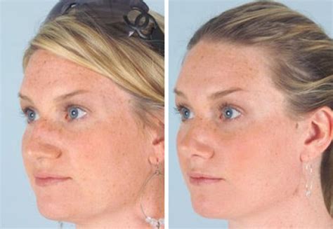 Rhinoplasty Surgeons Houston Spring Tx Cilento Facial Plastics