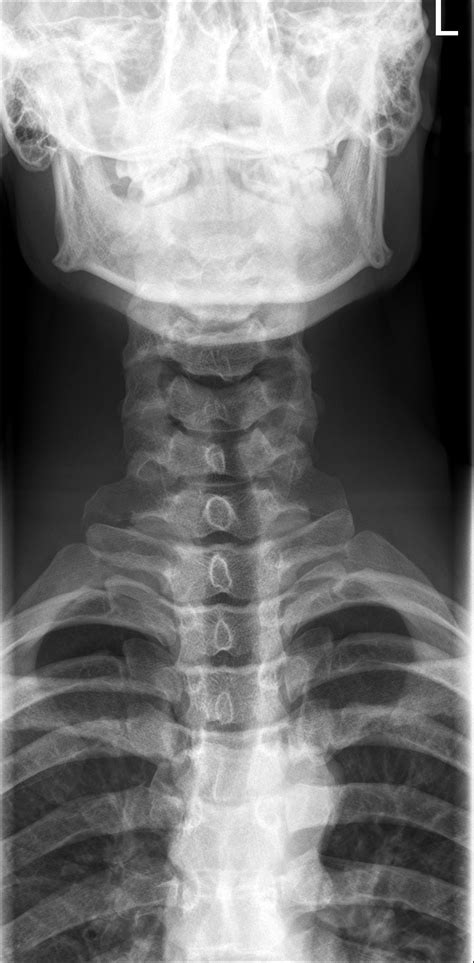 Pulmonary sarcoid on cervical spine x ray - anavolf