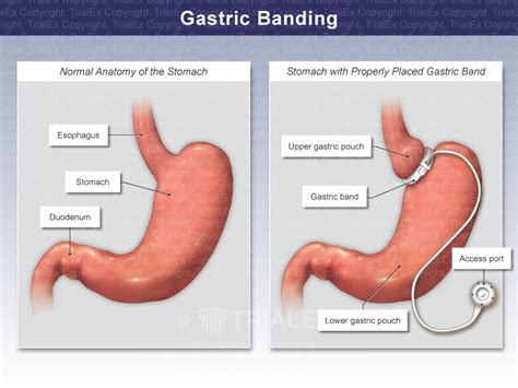 Nasal Gastric Tube Insertion Trial Exhibits Inc Hot Sex Picture