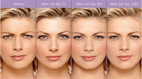 Botox Dysport Before And After The Beauty Clinic