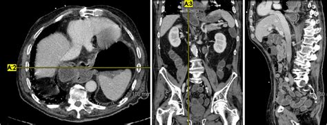 Axial And Coronal Views On Contrast‐enhanced Abdominal Computed