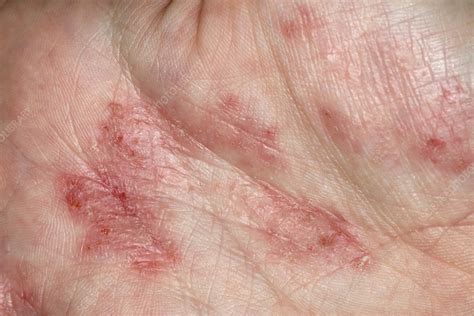 Shingles On Palms Of Hands