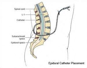 Spinal or Epidural Catheters Oak Park | Epidural Catheter Placement Chicago