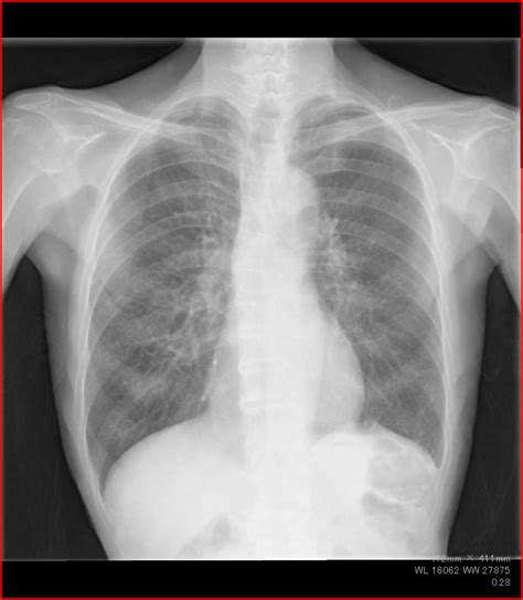 download Pulmonary Edema Fine Crackles - fileability