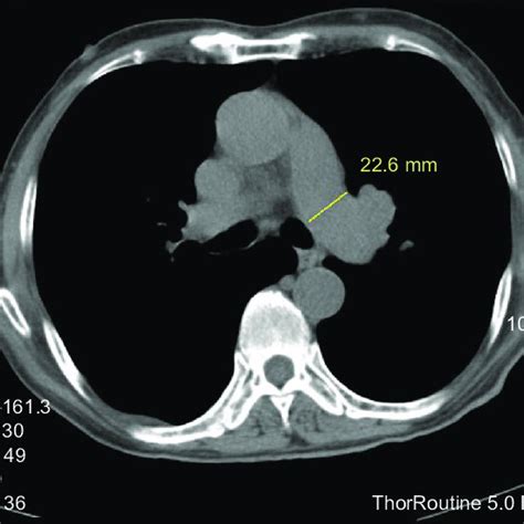 Measurement Of Left Pulmonary Artery LPa Diameter At The Widest Part