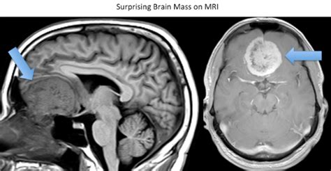 The Pregnancy Test” For Brain Cancer Rocky Mountain Brain And Spine