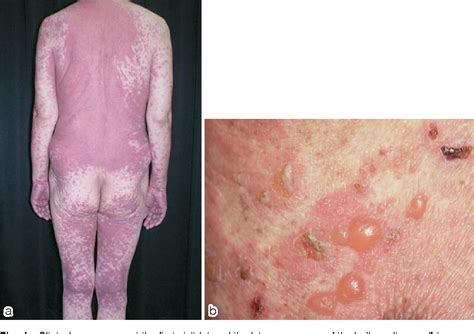 Figure 1 From Does Drug Induced Hypersensitivity Syndrome Elicit