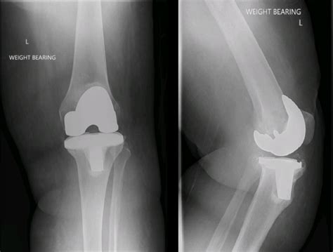 Knee And Hip Revision Surgery David Mckenna Orthopaedics