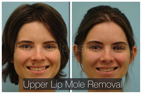 Mole Removal Surgery On Face - Sander